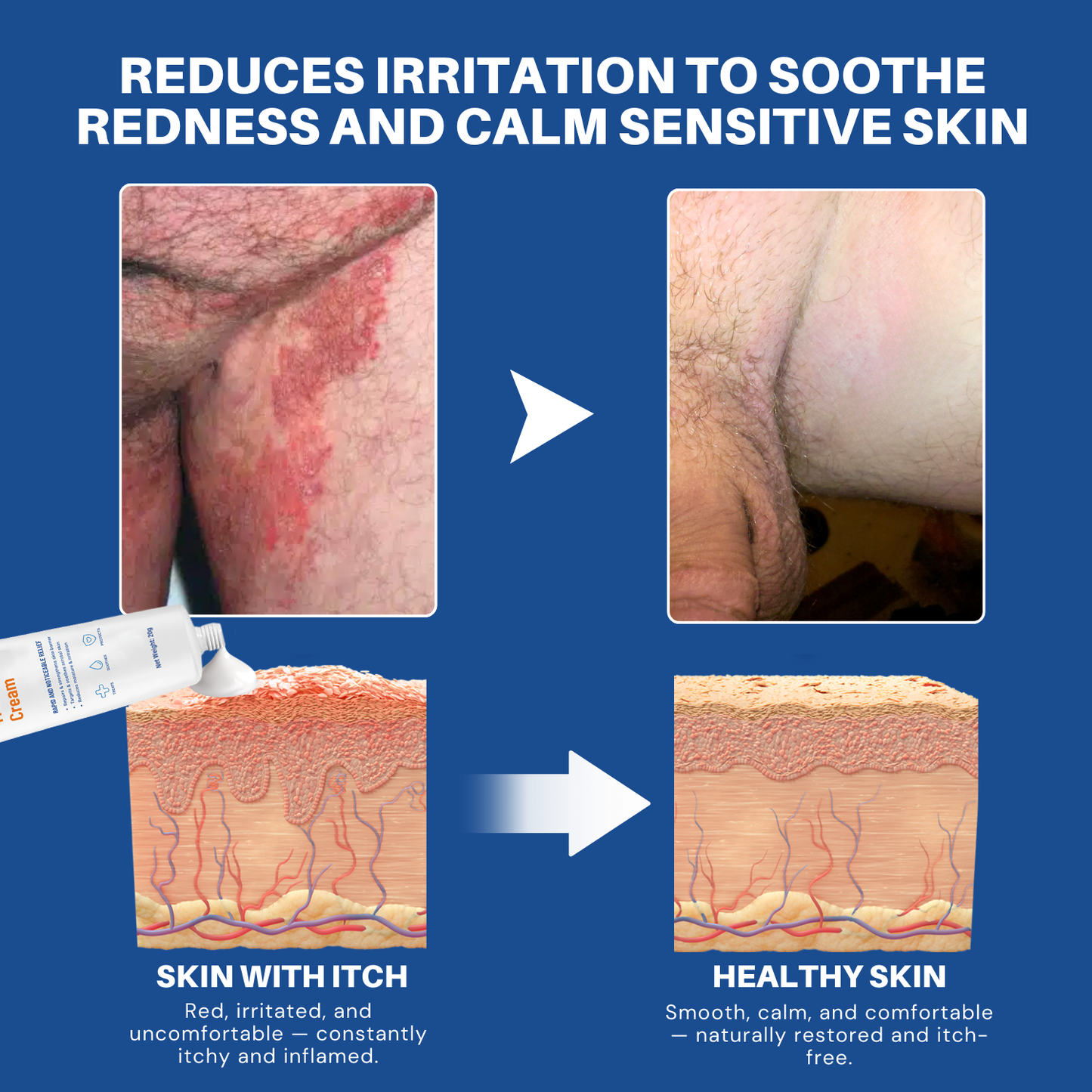 Scrotum Itchy Treatment Cream