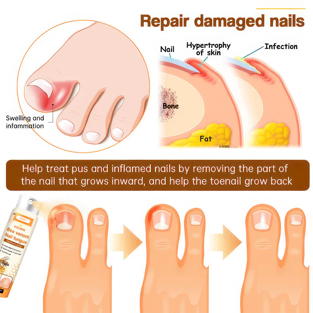 💥 2025 Limited 70% OFF ️⏳ Kolirin Bee Venom Nail Fungus Spray 💥 Fix All Nail Problems within 2 Weeks